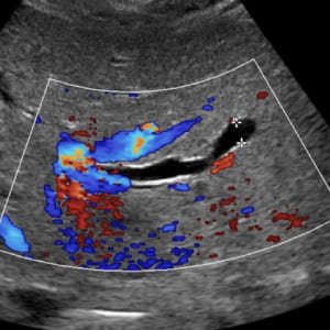 Ecografía Doppler Materno Fetal