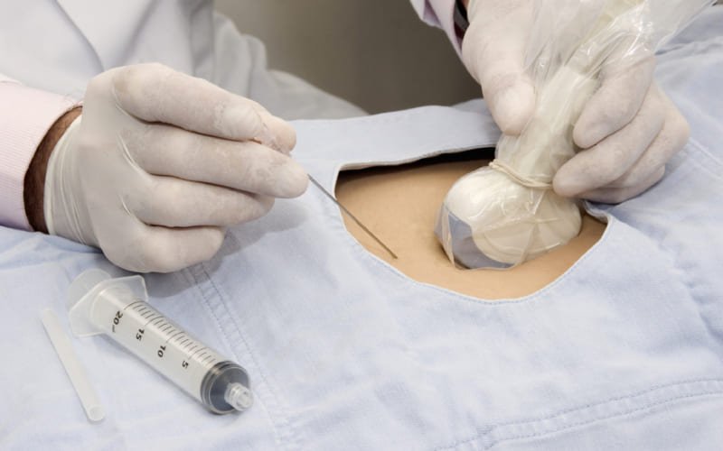 Amniocentesis en Querétaro